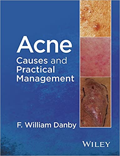 Acne: Causes and Practical Management