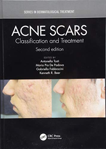 Acne Scars