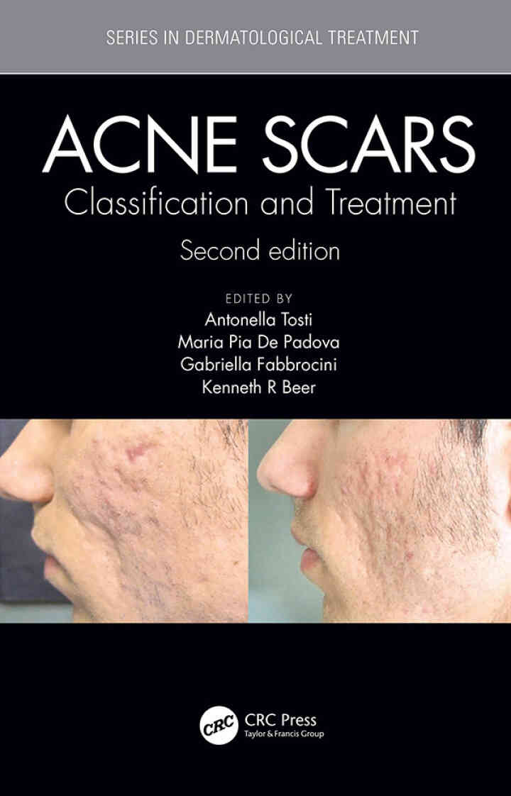 Acne Scars: and Treatment
