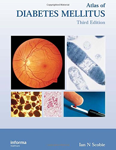 Atlas of Diabetes Mellitus