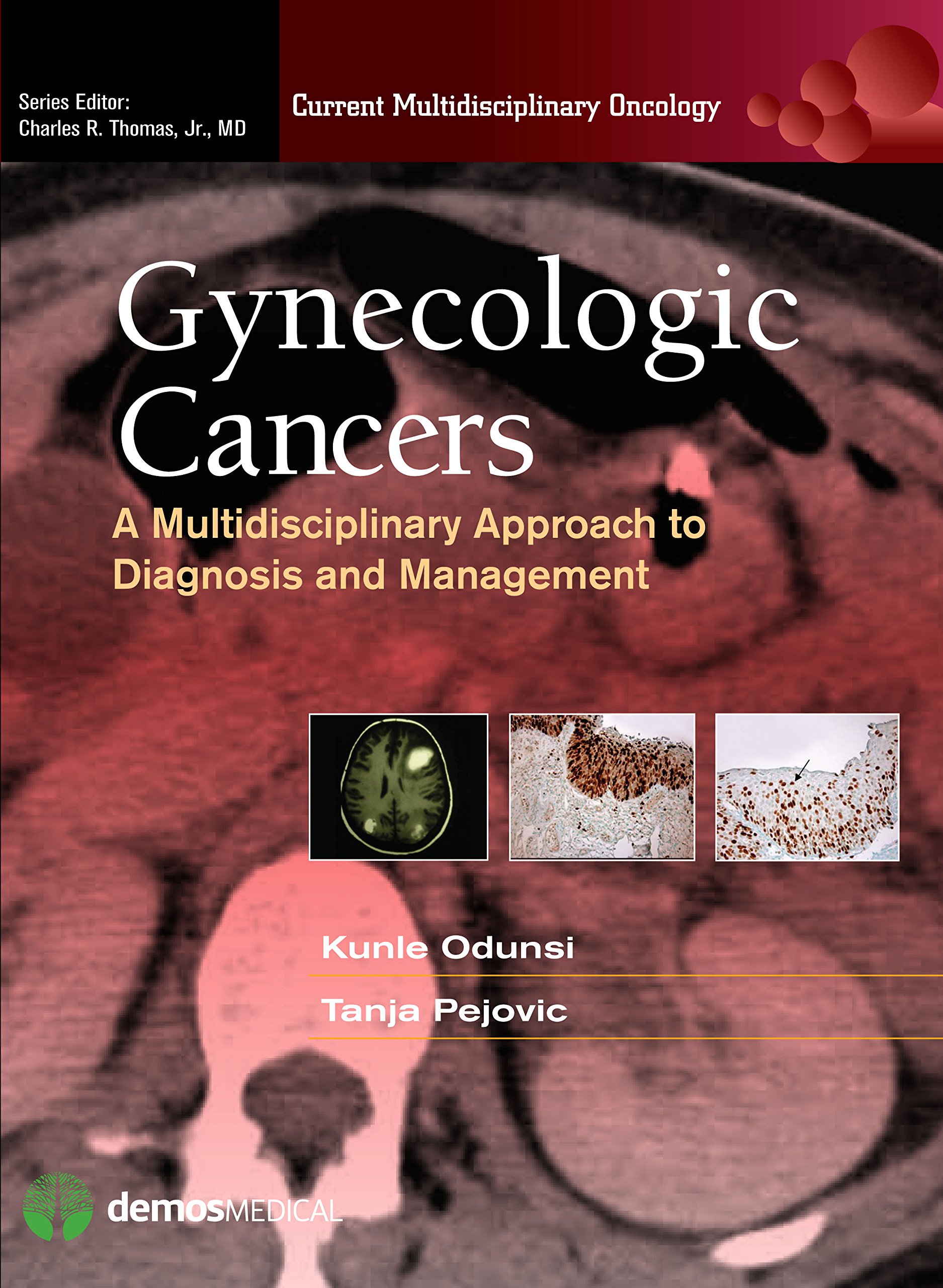 Gynecologic Cancers: A Multidisciplinary Approach to Diagnosis and Management