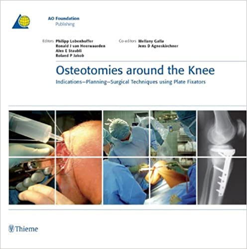 Osteotomies around the Knee: Indications-Planning-Surgical Techniques using Plate Fixators (AO-Publishing)