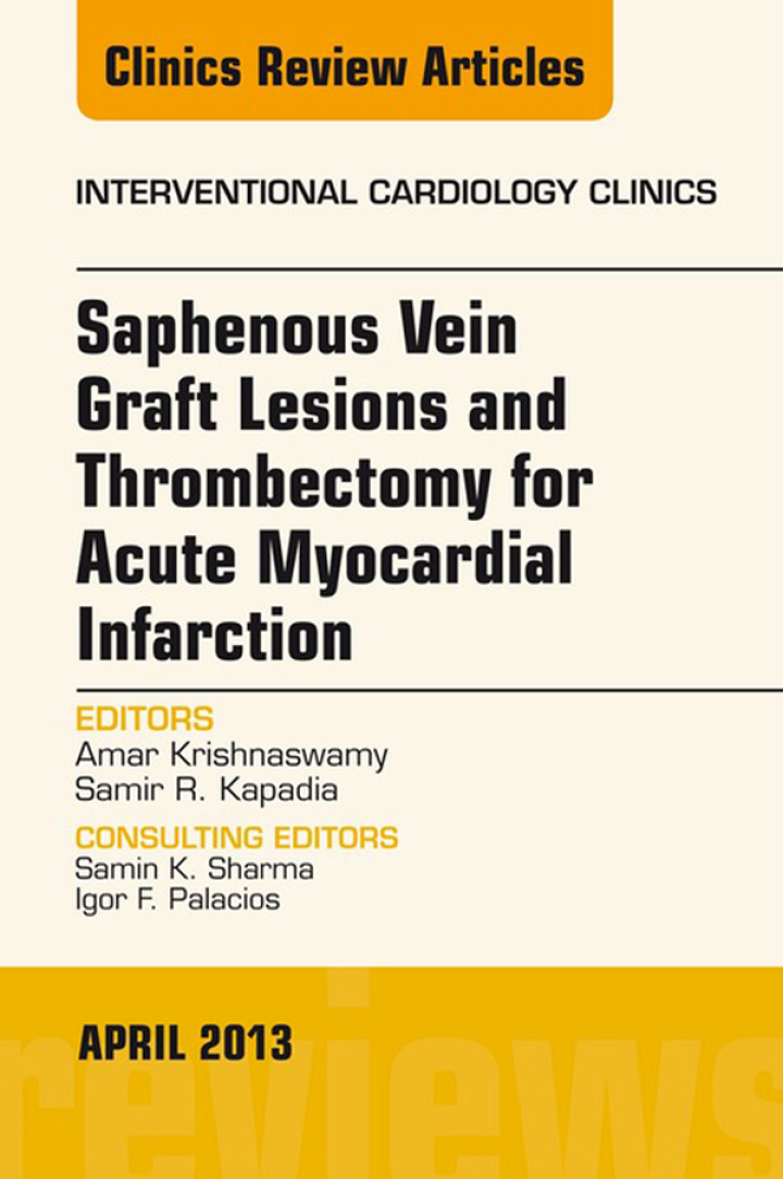 Saphenous Vein Graft Lesions and Thrombectomy for Acute Myocardial Infarction, An Issue of Interventional Cardiology Clinics