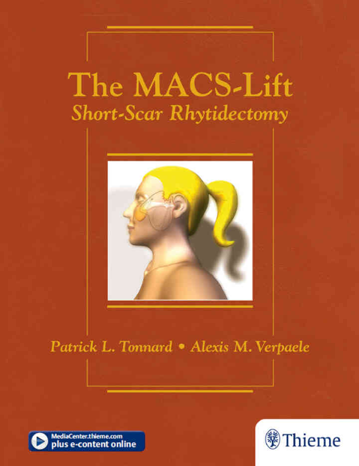 The MACS-Lift: Short-Scar Rhytidectomy